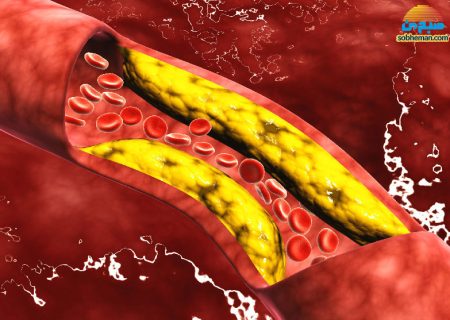 آیا پاکسازی عروق از کلسترول، امکان‌پذیر است؟