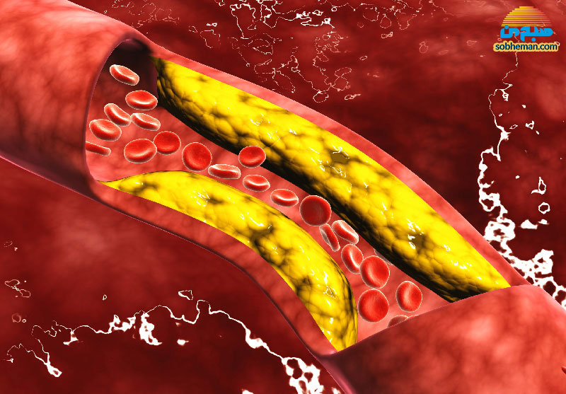 آیا پاکسازی عروق از کلسترول، امکان‌پذیر است؟