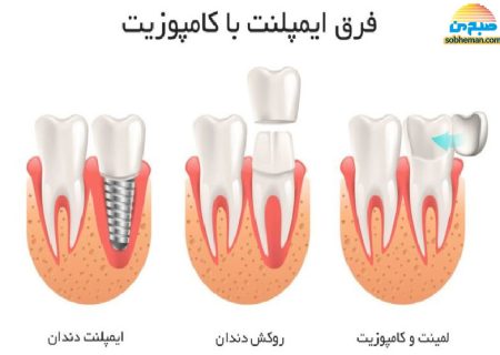 تفاوت «ایمپلنت» با «کامپوزیت» در چیست؟