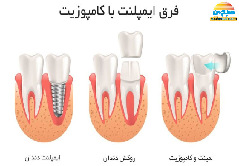 تفاوت «ایمپلنت» با «کامپوزیت» در چیست؟