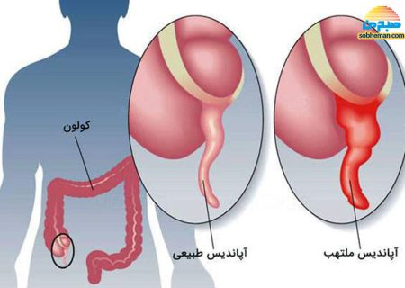 آپاندیسیت؛ از علائم تا شیوه درمان