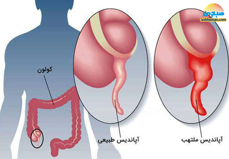 آپاندیسیت؛ از علائم تا شیوه درمان