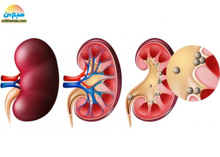 تصویری عجیب از سنگ کلیه زیر میکروسکوپ الکترونی
