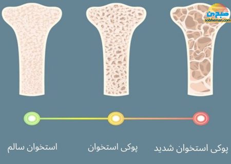 پوکی استخوان؛ یک بیماری خاموش