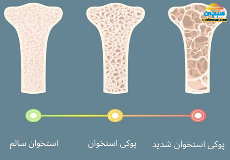 پوکی استخوان؛ یک بیماری خاموش