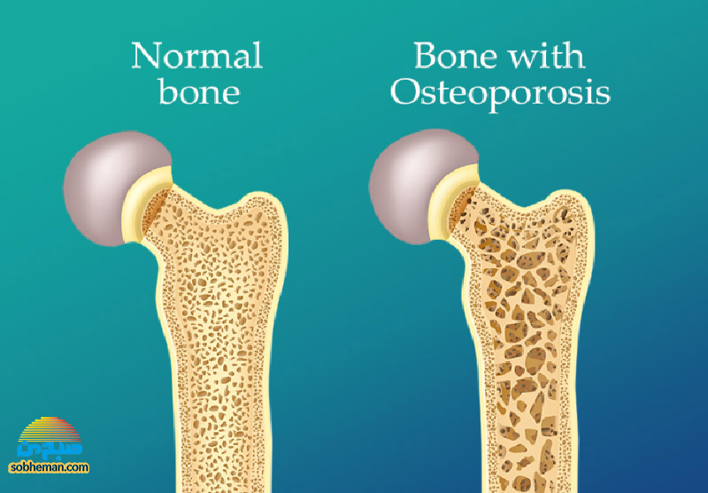 (اینفوگرافیک) اگر این علایم را دارید، پوکی استخوان را جدی بگیرید