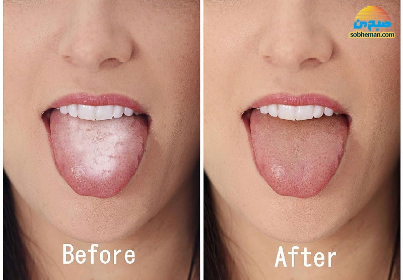 ترفندهای تمیز کردن زبان برای رهایی از بوی بد دهان