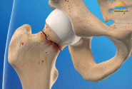 کمک به بهبودی شکستگی استخوان با طب سنتی