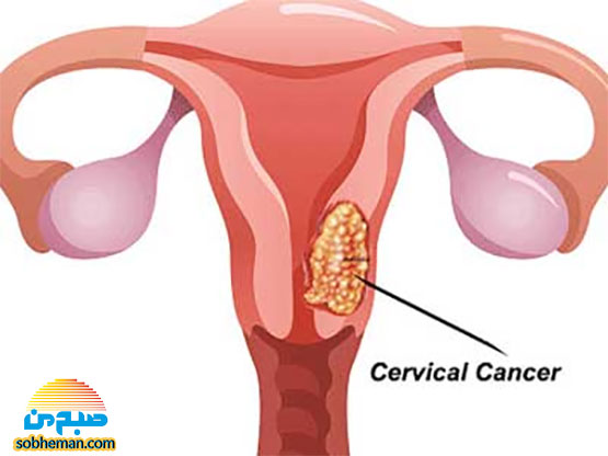 سرطان دهانه رحم